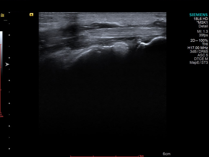 УЗД як детектив: історія про хибну подагру