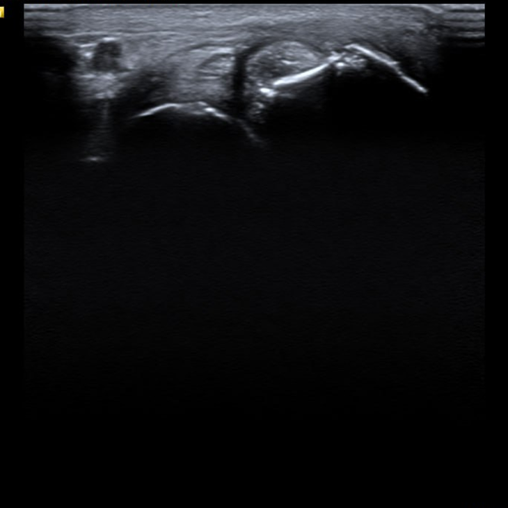 Ілюзія зцілення та незворотність часу — роль УЗД у діагностиці псоріатичного артриту