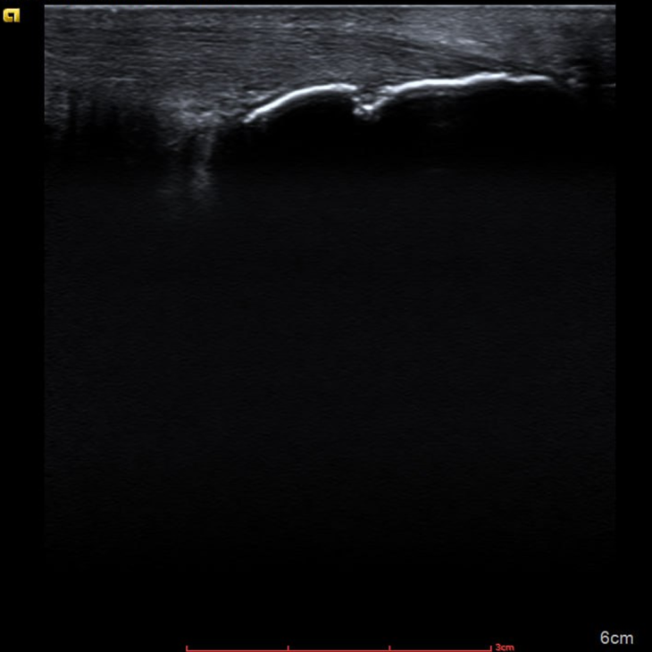 Ілюзія зцілення та незворотність часу — роль УЗД у діагностиці псоріатичного артриту