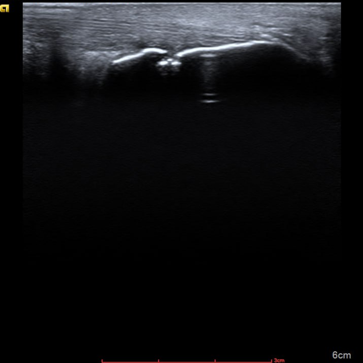 Ілюзія зцілення та незворотність часу — роль УЗД у діагностиці псоріатичного артриту