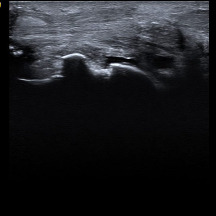 Ілюзія зцілення та незворотність часу — роль УЗД у діагностиці псоріатичного артриту