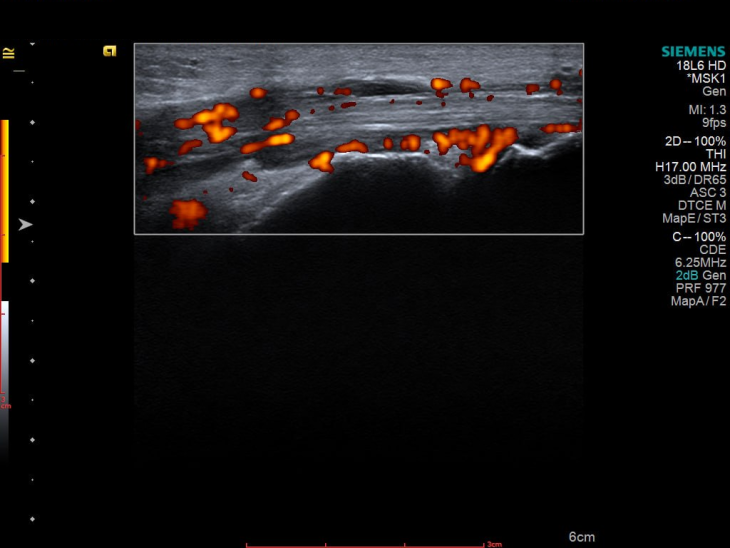 УЗД як детектив: історія про хибну подагру