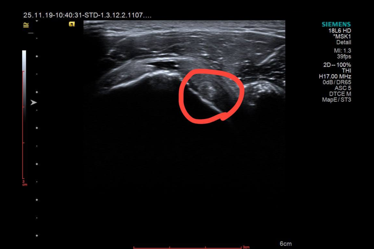 Плечовий біль — діагностичні пастки та роль ультразвуку