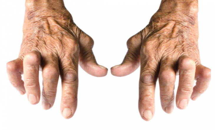 Фенотип ревматоїдного артриту