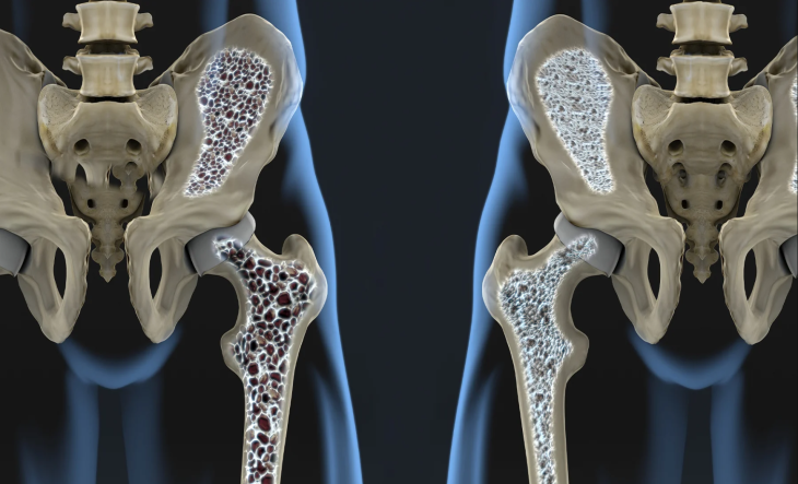 Поради пацієнтам щодо лікування остеопорозу